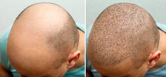 Ihre Lösung für Haargesundheit: Haarausfall Nürnberg